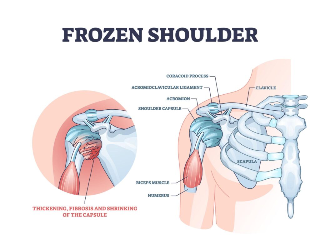 Frozen Shoulder: Muscles Involved and the Role of Medical Yoga