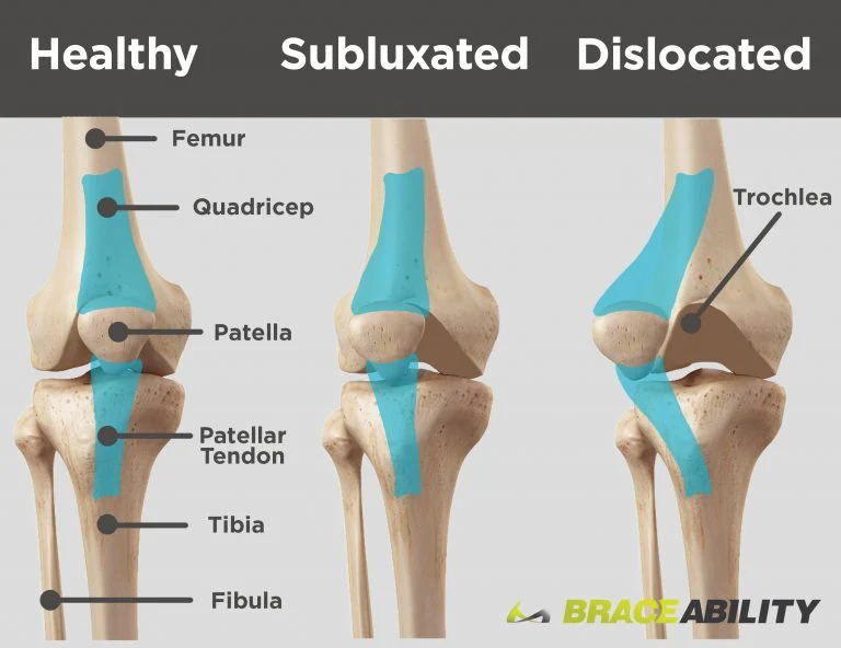 Patellar Shift