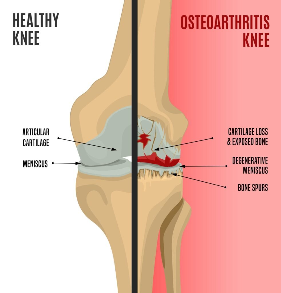 Myths around knee osteoarthritis